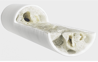 OSTEOPOROSIS