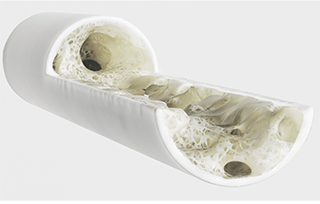 SEVERE OSTEOPOROSIS